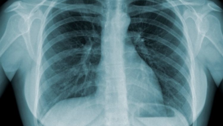 A urgência da luta contra a tuberculose em meio à pandemia de coronavírus